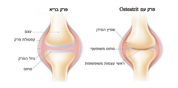 דלקת פרקים osteatrit - תרשים