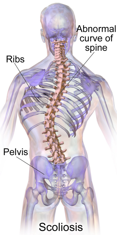 Blausen_0785_Scoliosis_01